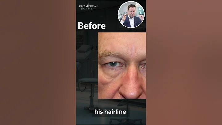 Brow Lift And Blepharoplasty - 70 Year Old Male #browlift