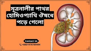 Ureter Stone Passed with Homeopathic Medicine | Hydronephrosis | Hydroureter | HD Homeo Sadan screenshot 5