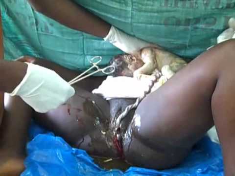 Episiotomy  Repair Episiotomy and delivery of the baby