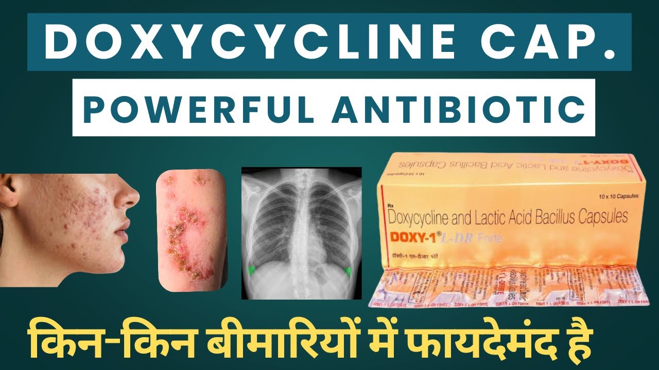Doxycyclin and lactic acid bacillus capsules doxy 1 L dr forte tablet in hindi
