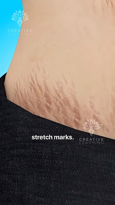 Why Do Stretch Marks Really Happen 😱 #shorts #viralvideo - Creativelearning3d