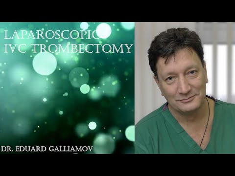 IVC Trombectomy / Тромбэктомия из НПВ,радикальная нефрэктомия справа.