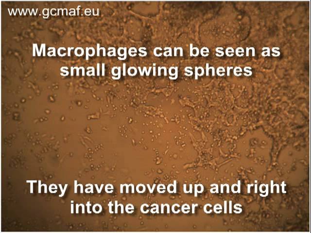 Cancer cells destroyed by First Immune GcMAF (gcmaf.eu)