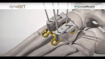 dynaMet™ Lesser TMT Fusion System Surgical Technique