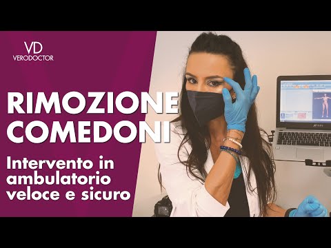 RIMOZIONE COMEDONI, detti punti neri, intervento in ambulatorio semplice e veloce - VERODOCTOR