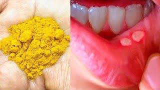 3 मिनट में मुँह और जीभ के छाले ठीक करने के लिए घरेलू उपाय How to get rid of Mouth Ulcer? screenshot 4