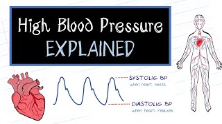 What is High Blood Pressure? (HealthSketch)