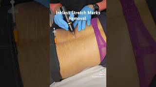 Inkless Stretch Marks Removal #scarremoval #StretchMarkRemoval #InklessTreatment #clearskin #Beauty