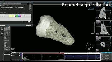 Tooth Segmentation using Ondemand3D