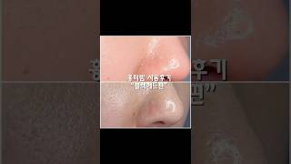 피지녹이는 흉터밤! 블랙헤드 관리방법