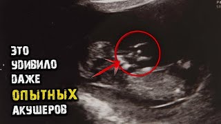 У Родителей Родилась Красивая Девочка, Но Одна Деталь Удивила Даже Опытных Акушеров