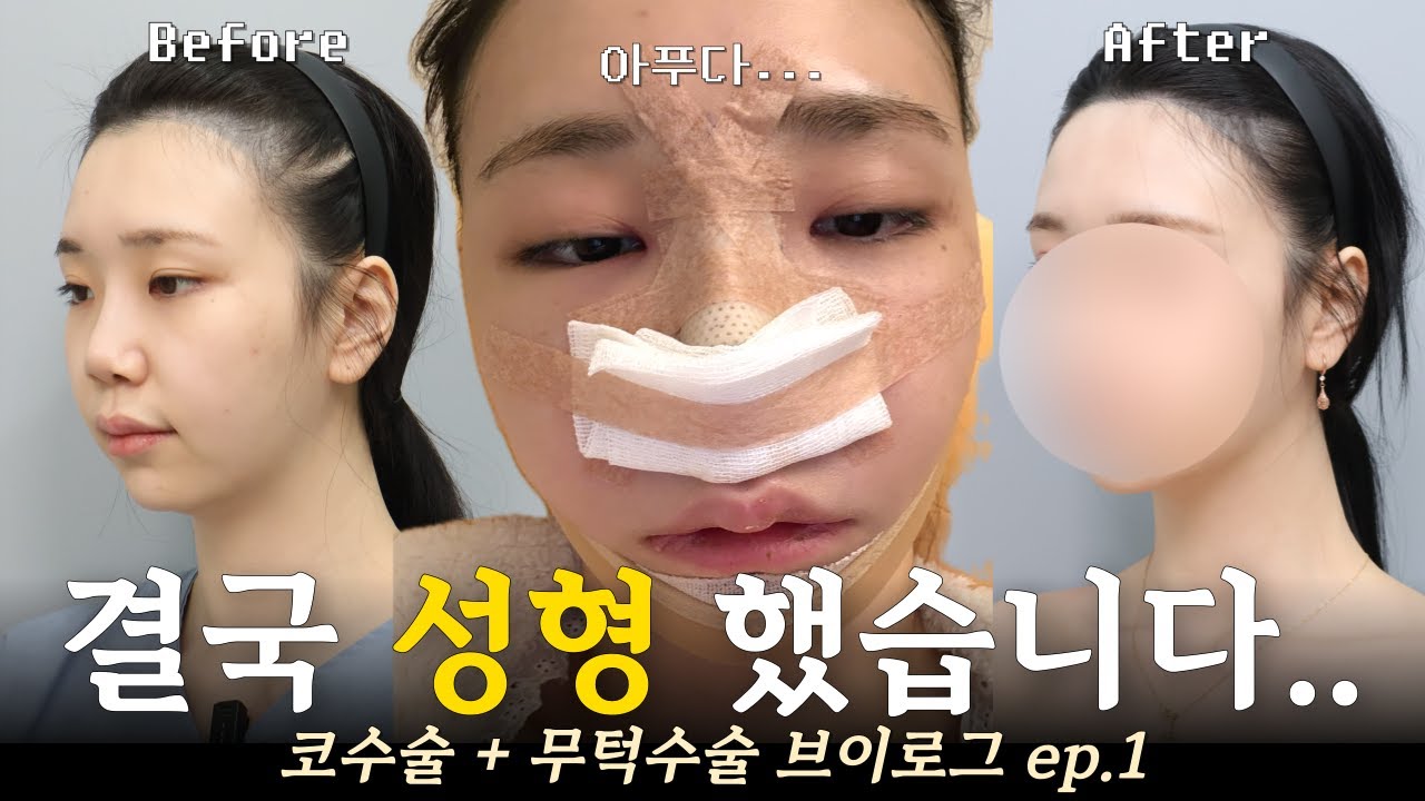 200% 리얼 코수술+무턱수술 브이로그 🥵 수술 당일부터 한 달차까지.. 험난한 여정..  | 낮고 들린 코 내돈내산으로 갈아엎기 | 자가늑연골 윤곽수술 턱끝전진술