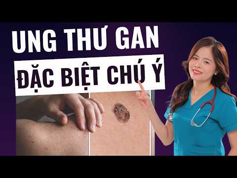5 SIGNS of LIVER CANCER "crying for help" you MUST PAY SPECIAL ATTENTION TO | Dr. Thùy Dung thumbnail