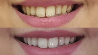 وصفة فعالة لتبييض الأسنان وإزالة الاصفرار     Blanchir les dents naturellement