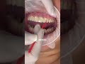 Smile makeover procedure cosmeticdentistry  dental crown procedure front teeth  dr yazdan