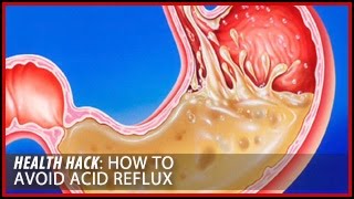 How to Avoid Acid Reflux: Health Hacks- Thomas DeLauer