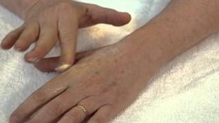 How to Massage a Scar - LB Hand Therapy