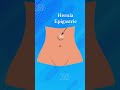 View the video on hernia epigastric surgery and select the top hospital and package in your location
