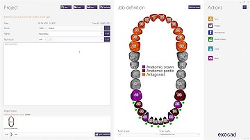 Tutorial - From Connect Case Center Inbox to Exocad based on Implant Indication