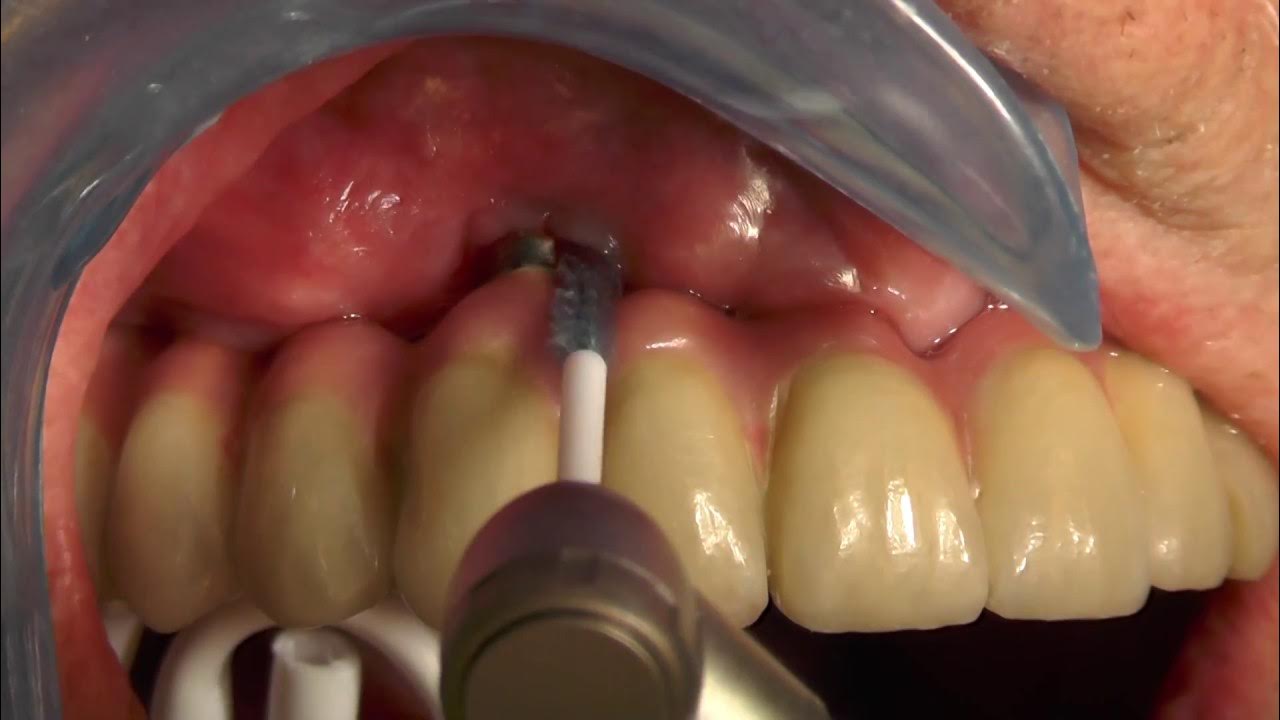 Debridement of a dental implant with LABRIDA BioClean YouTube