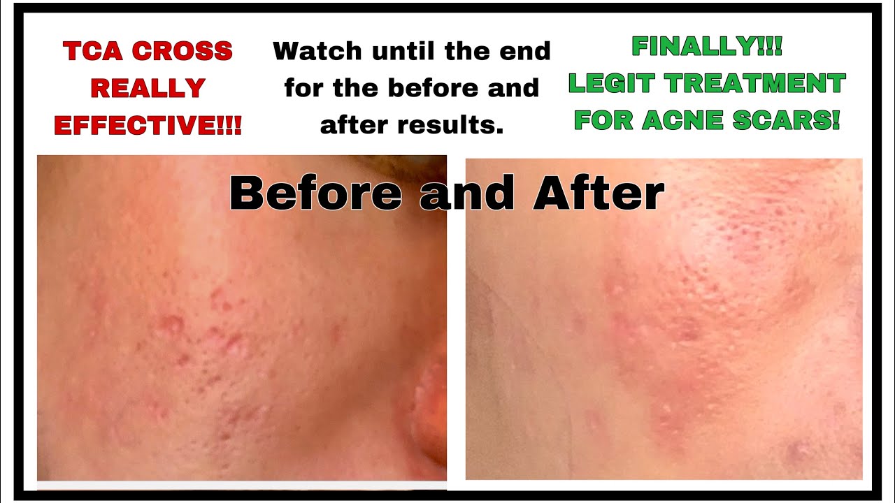 TCA CROSS BEFORE AND AFTER TCA CROSS PHILIPPINES TCA CROSS AT HOME tca-cross-before-and-after-tca-cross-philippines-tca-cross-at-home