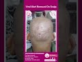 Scalp Wart Removal Treatment | Viral Wart Removal On Scalp | Dr Vimala's Skin, Hair & Laser Centre
