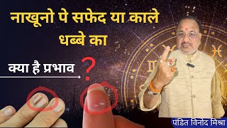 || नाखूनो पे सफेद या काले धब्बे का प्रभाव क्या हैं (Nakhun Par Safed ya kale dhabbe) Nail explain