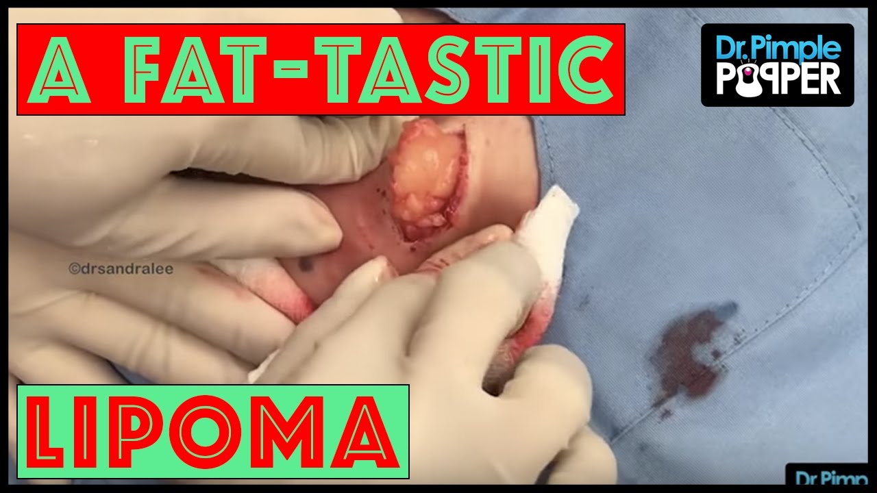 Who Thinks Lipomas are FAT-tastic? - Published on Feb 6, 2017