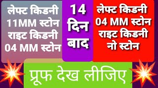 किडनी स्टोन को निकालने की सबसे अच्छी दवा होम्योपैथिक में || Kidney Stone Eliminator || Best Medicine