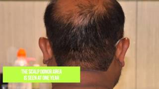 Hair Transplant for Extensive Balding by Dr. Bhatti | Darling Buds - YouTube