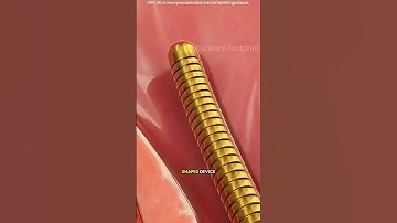 Intrauterine device (iuds) for birth control #drone #theflash #space #automobile #scifi #rocket