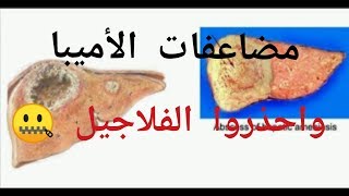 الأميبا (الانتميبا هيستوليتكا)مخاطر الإصابه وكيفيه العلاج بالشكل الصحيح