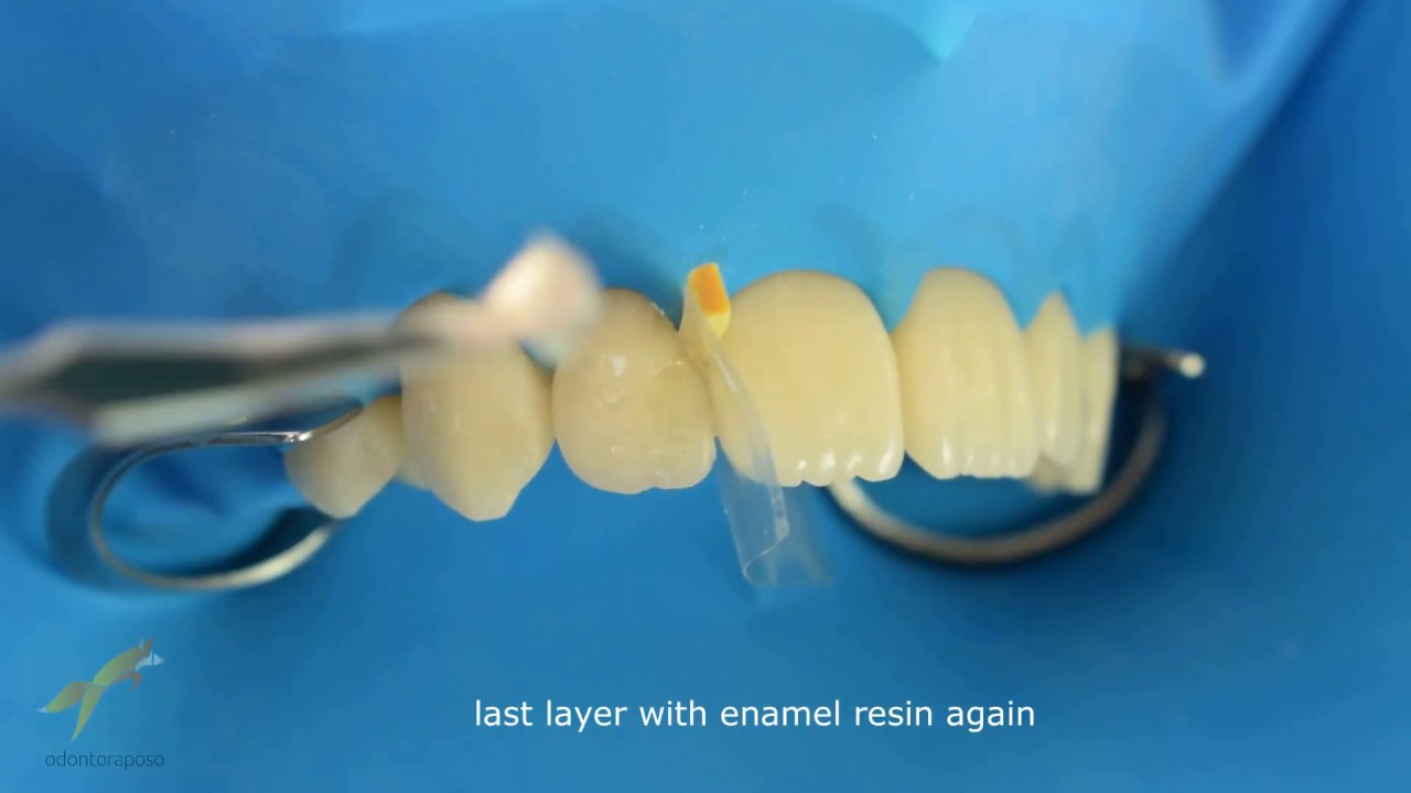 CLASSE 3 Resina Composta