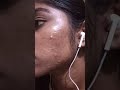 My pimple transformation within 3 months /#missnithya