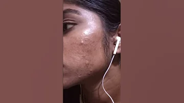 My Pimple Transformation Within 3 Months Missnithya 