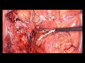 Laparoscopic Management of Diverticular Colovesical Fistula