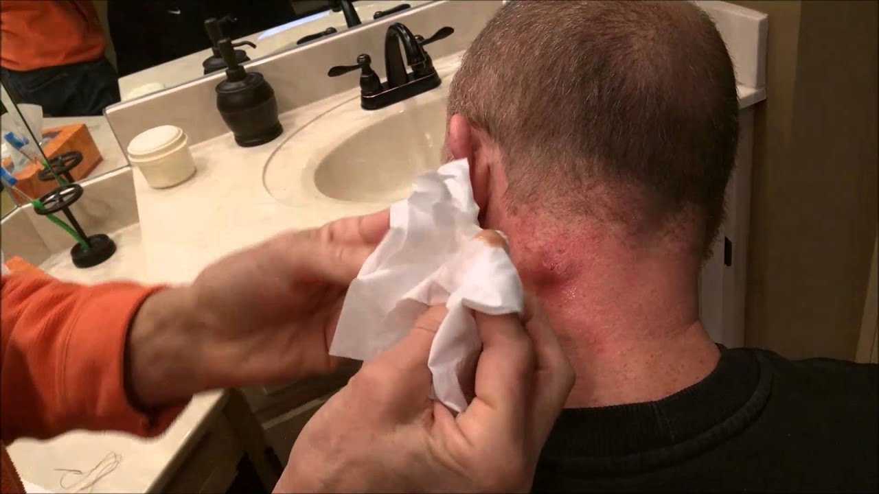 Pimplesebaceous Cyst Popping Youtube