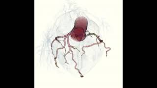 Right Coronary Lesion primarily soft plaque.  Noise reduction by Pixelshine (Algomedica)