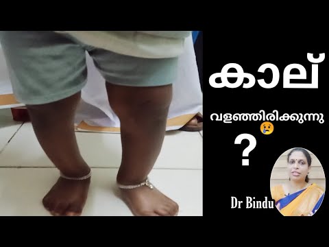 കാല് വളഞ്ഞിരുന്നാൽ എന്തു ചെയ്യണം/ഉഴിഞ്ഞാൽ മാറുമോ/Bowing of legs/Dr Bindu