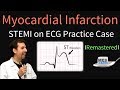 Myocardial Infarction / STEMI on ECG - Practice EKG