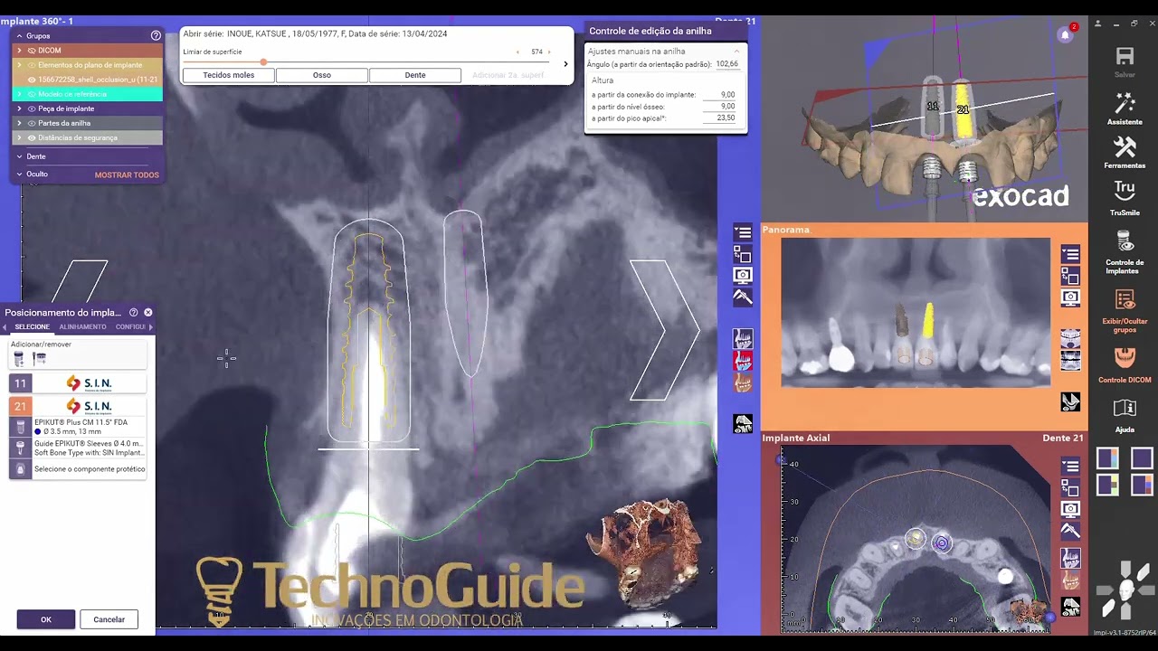Assistir vídeo sobre Implantes