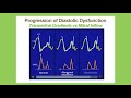 Echocardiographic Assessment of Diastolic Function: A Joint Presentation of IAC, ASE and SDMS