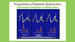 Echocardiographic Assessment of Diastolic Function: A Joint Presentation of IAC, ASE and SDMS