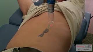 Black Ink Tattoo Removal in Sarasota FL by ReversaTatt Tattoo Removal