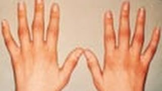 Dr. prasad, ayurveda doctor telling about ayurvedic treatments for
arthritis. more details click on
-http://www.indiavideo.org/malayalam/arthritis-ayurve...