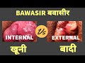 EXTERNAL VS INTERNAL HEMMORHOIDS - DIFFERENCE - खूनी और बादी बवासीर क्या है ?