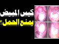 هل وجود كيس على المبيض يمنع الحمل أنواع كيسات المبيض وعلاجها كيف تتكون أكياس المبيض الوظيفية