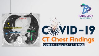 Covid19 CT Chest Findings.