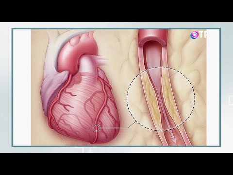 Видео: Болезнь коронарной артерии: причины, симптомы и методы лечения