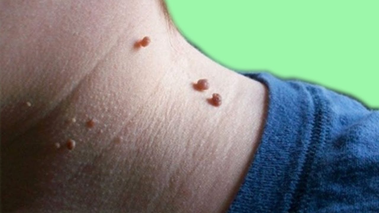 Папилломы — они сигнализируют?, нет, они кричат о вирусной инфекции ...